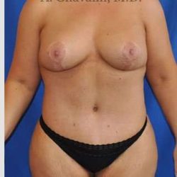 Mommy Makeover Before & After Patient #7387