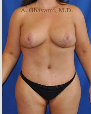 Mommy Makeover Before & After Patient #7387