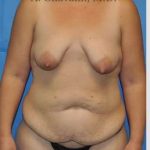 Mommy Makeover Before & After Patient #7387