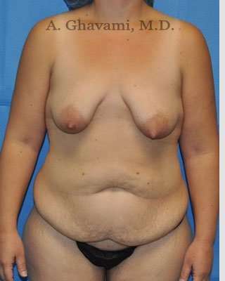 Mommy Makeover Before & After Patient #7387