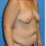 Mommy Makeover Before & After Patient #7387