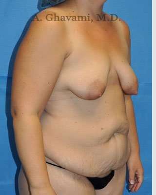 Mommy Makeover Before & After Patient #7387