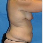 Mommy Makeover Before & After Patient #7387
