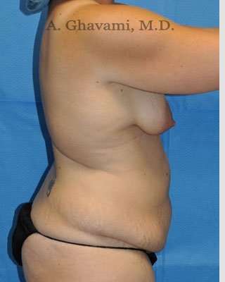 Mommy Makeover Before & After Patient #7387