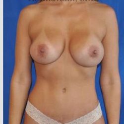 Mommy Makeover Before & After Patient #7380