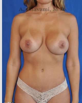Mommy Makeover Before & After Patient #7380