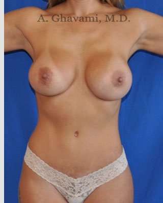 Mommy Makeover Before & After Patient #7380