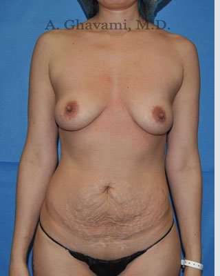 Mommy Makeover Before & After Patient #7380