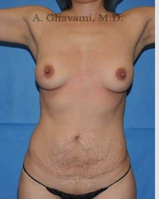 Mommy Makeover Before & After Patient #7380