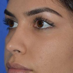Nose And Face Before & After Patient #8354
