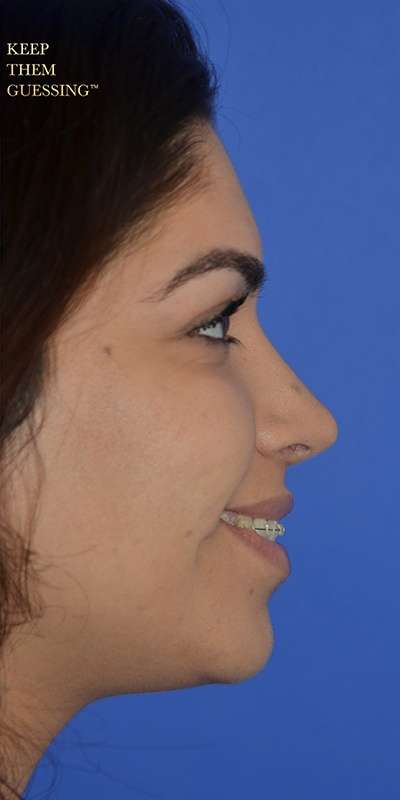 Nose And Face Before & After Patient #8354