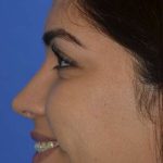 Nose And Face Before & After Patient #8354
