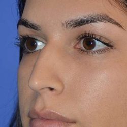 Nose And Face Before & After Patient #8354