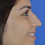 Nose And Face Before & After Patient #8354