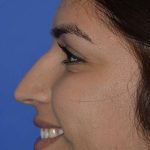 Nose And Face Before & After Patient #8354