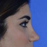 Nose And Face Before & After Patient #8347
