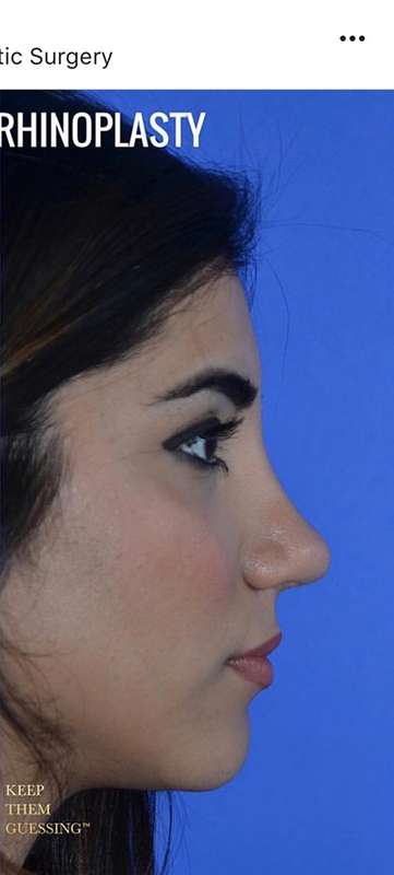 Nose And Face Before & After Patient #8347