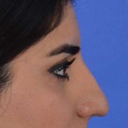 Nose And Face Before & After Patient #8347