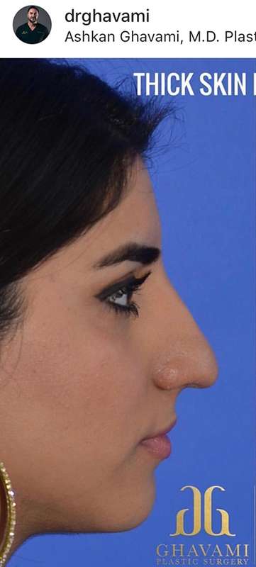 Nose And Face Before & After Patient #8347