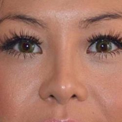 Nose And Face Before & After Patient #8341