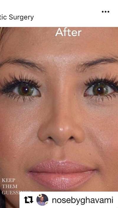 Nose And Face Before & After Patient #8341