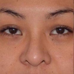 Nose And Face Before & After Patient #8341