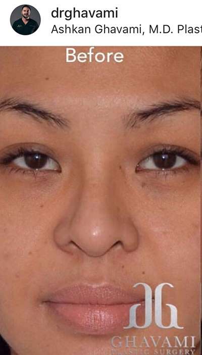 Nose And Face Before & After Patient #8341