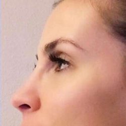 Nose And Face Before & After Patient #8338