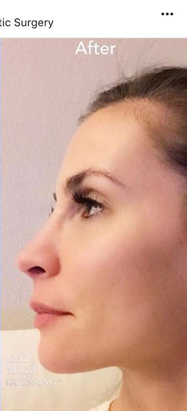 Nose And Face Before & After Patient #8338