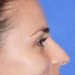 Nose And Face Before & After Patient #8338