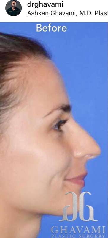 Nose And Face Before & After Patient #8338
