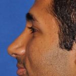 Nose And Face Before & After Patient #8335