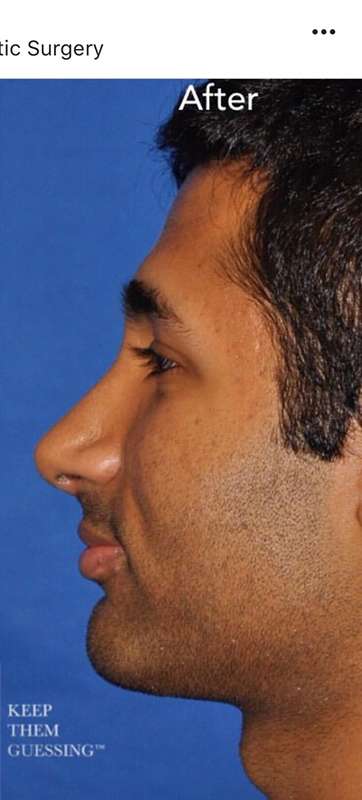 Nose And Face Before & After Patient #8335