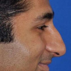 Nose And Face Before & After Patient #8335
