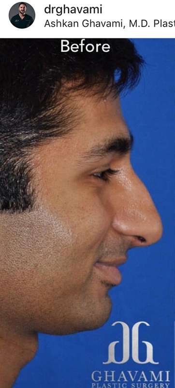 Nose And Face Before & After Patient #8335