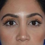 Nose And Face Before & After Patient #8332