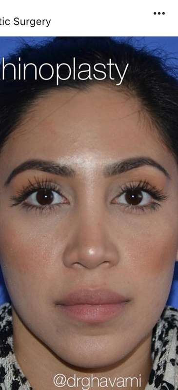 Nose And Face Before & After Patient #8332