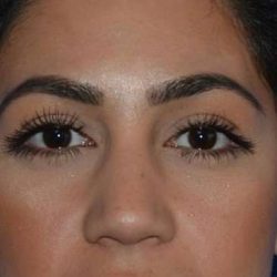 Nose And Face Before & After Patient #8332