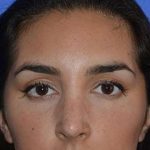 Nose And Face Before & After Patient #8329