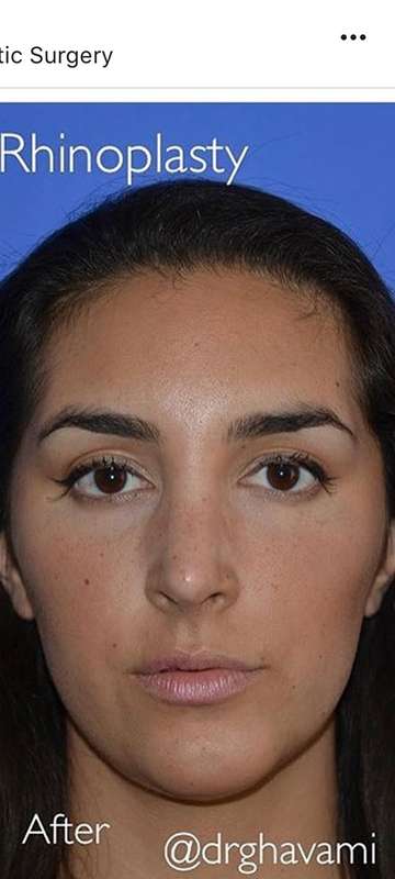 Nose And Face Before & After Patient #8329