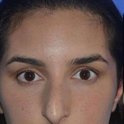 Nose And Face Before & After Patient #8329