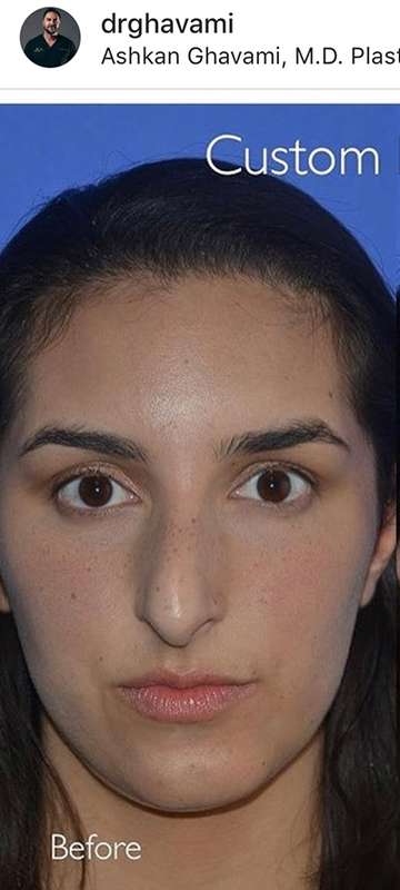 Nose And Face Before & After Patient #8329