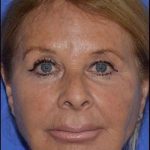 Nose And Face Before & After Patient #8326