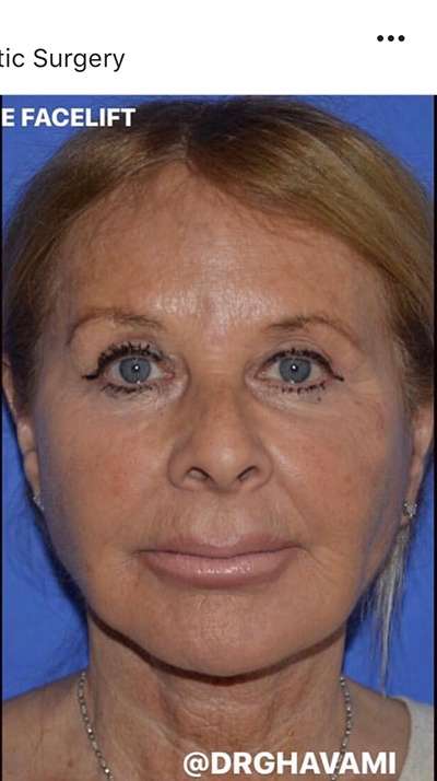 Nose And Face Before & After Patient #8326