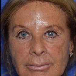 Nose And Face Before & After Patient #8326