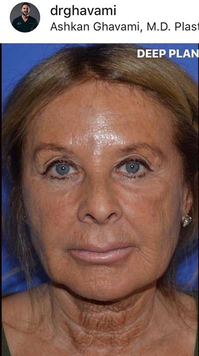 Nose And Face Before & After Patient #8326