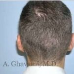 Otoplasty Before & After Patient #7371