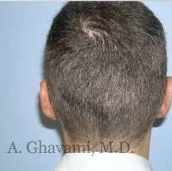 Otoplasty Before & After Patient #7371