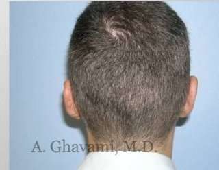 Otoplasty Before & After Patient #7371