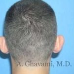 Otoplasty Before & After Patient #7371